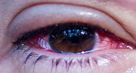 194x105_Conjunctivitis_pink_eye